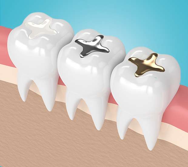 Murrieta Composite Fillings