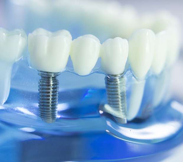 Murrieta Dental Implants