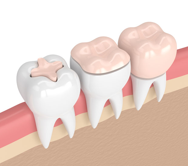 Murrieta Dental Inlays and Onlays