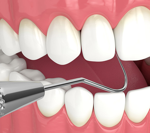 Murrieta Interactive Periodontal Probing